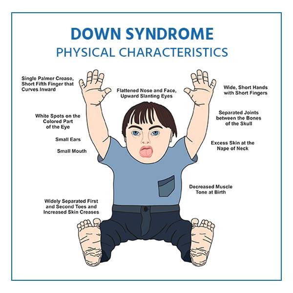 down-syndrome-symptoms